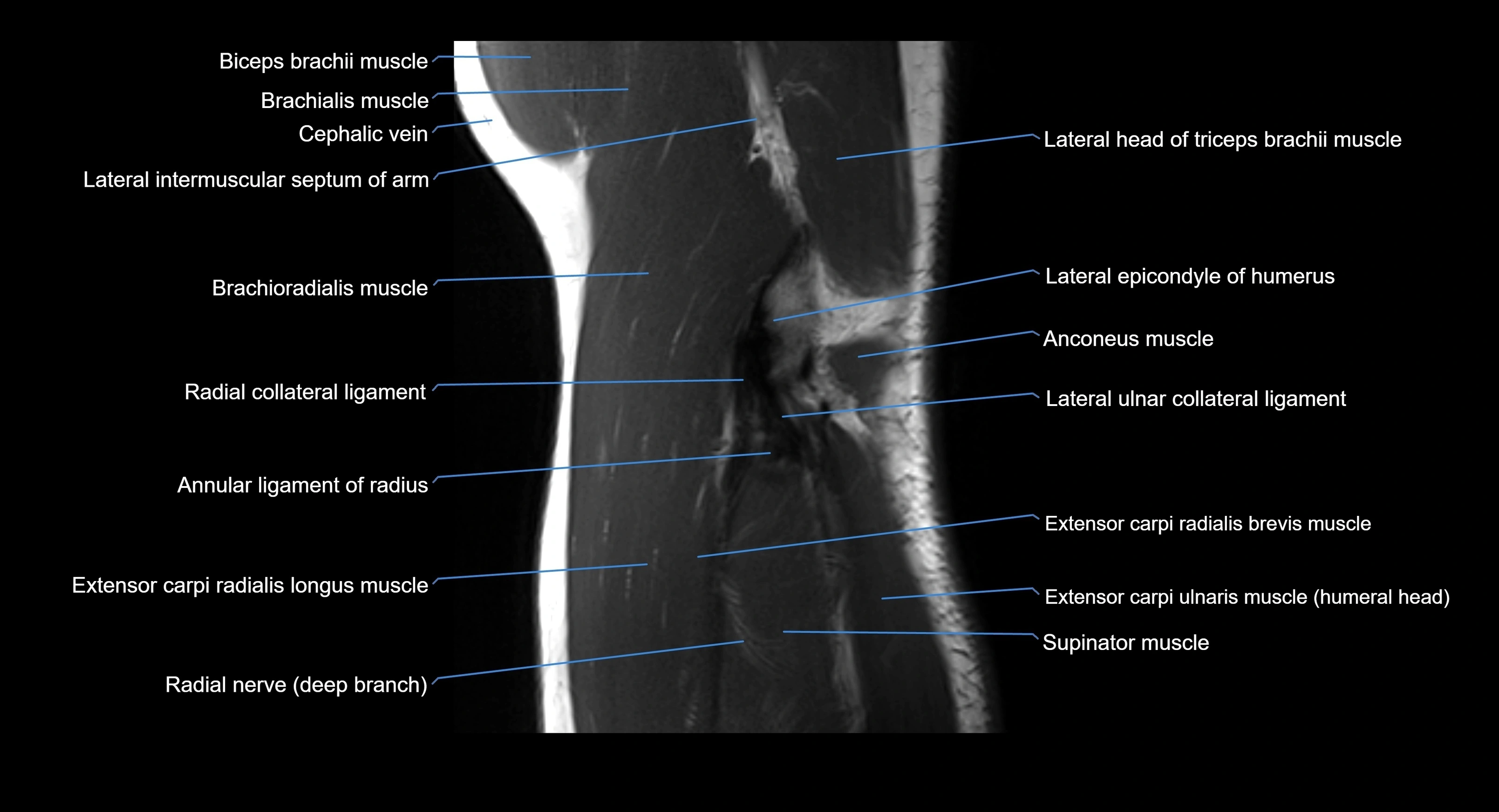 MRI elbow joint  sagittal cross sectional anatomy 3T  radiology  image-img-00001-00020.webp